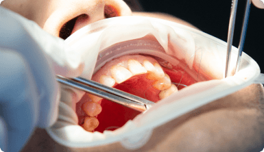 ¿Sientes molestias post endodoncia?