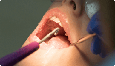 ¿Que se siente después de tu limpieza dental?