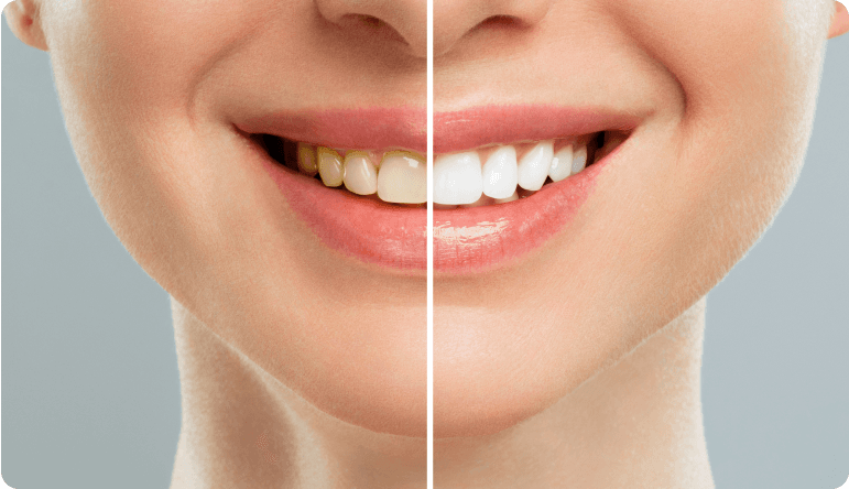 Aclaramiento dental