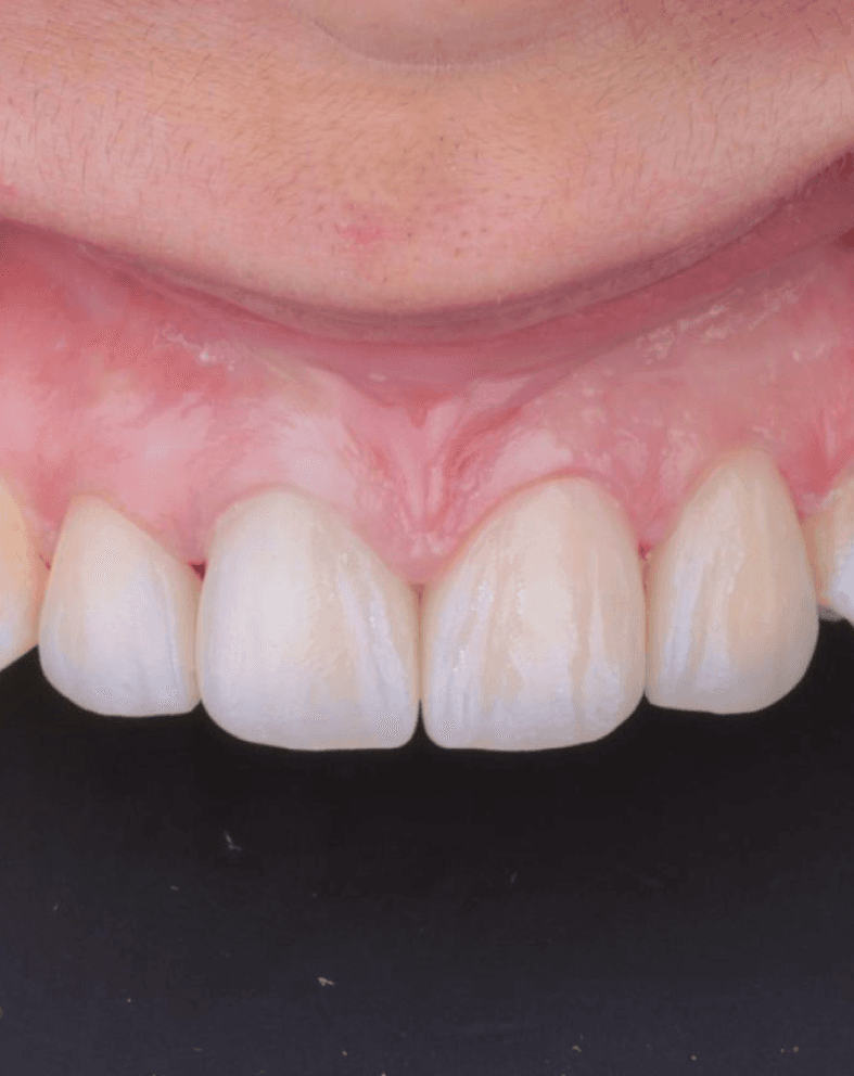 Corona de zirconia